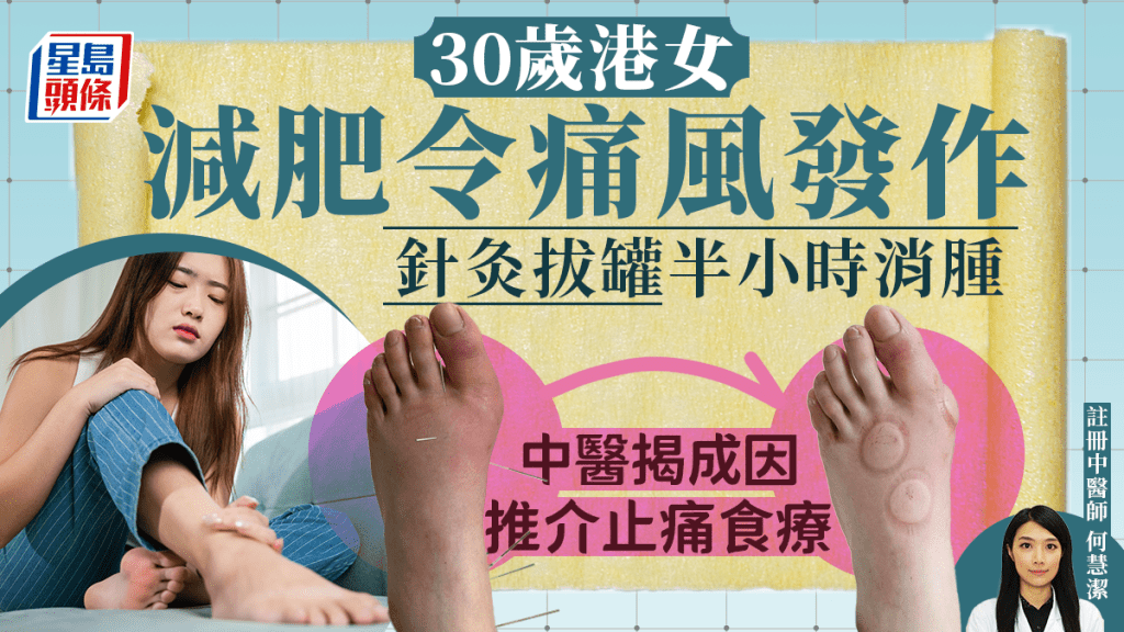 痛风饮食｜30岁港女减肥引发痛风 中医治疗30分钟消肿 附止痛食物/戒口清单